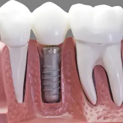 Czy po wszczepieniu implantu zęba można iść do pracy bez obaw?