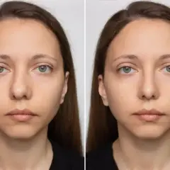 Porównanie twarzy przed i po operacji przegrody nosowej.