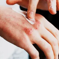 Alergia na sierść objawy skórne – jak rozpoznać i leczyć dolegliwości