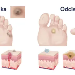 Ilustracja porównuje kurzajki i odciski na stopach. Odcisk na stopie po angielsku to "corn".
