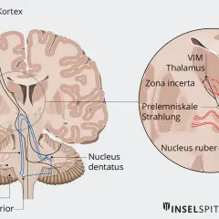 Hirnschnitt mit Darstellung von Nervenbahnen, die vom Kortex zum Thalamus und Kleinhirn verlaufen. Der primäre Fokus liegt auf dem Thalamus und seinen Verbindungen.