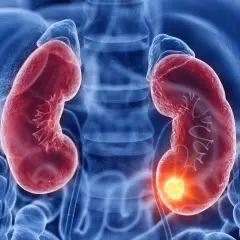 Darstellung von Nieren mit einem leuchtenden Tumor, der auf ein Nierenzellkarzinom hinweist, im Einklang mit der S3-Leitlinie.