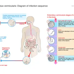 Schema zeigt Übertragung von Parasiten im Körper: Symptome bei Frauen durch Wurmeier, Larven, erwachsene Würmer im Darm und Eiablage am Anus.
