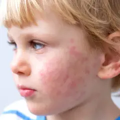 Primo piano del viso di un bambino con macchie rosse sulle guance, possibili macchie allergie alimentari bambini.