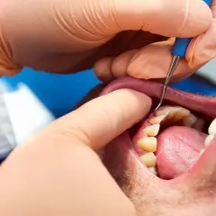 Dentista esamina i denti per valutare la parodontite, cercando i migliori rimedi per la salute gengivale.