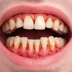 Encías inflamadas y enrojecidas alrededor de los dientes, indicativo de periodontitis leve.