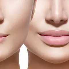Prima e dopo: labbra più piene e definite grazie all'acido ialuronico, che attenua le rughe del contorno labbra.