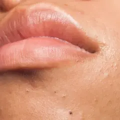 Gros plan sur des lèvres et une peau présentant des points noirs, un aperçu de comment enlever les comédons pour une peau nette.