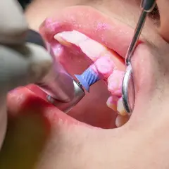 Dettaglio di un trattamento di igiene orale: il dentista usa uno strumento rotante per pulire i denti, coperti da una pasta rosa.