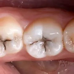 Denti con piccole carie scure nelle fessure.