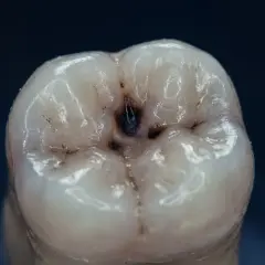 Dente con una cavità scura al centro, un chiaro segno di carie. I sintomi iniziali possono essere sottili, ma questa immagine mostra la progressione.