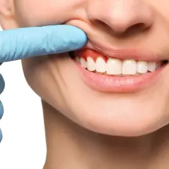 Dłoń w niebieskiej rękawiczce odsłania zaczerwienione dziąsło. Czas na antybiotyk na zęba i wizytę u dentysty.