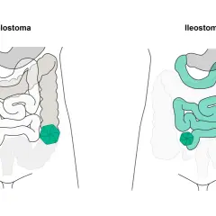 Vergleich von Kolostoma und Ileostoma: zwei verschiedene stoma arten, die den Darm betreffen.