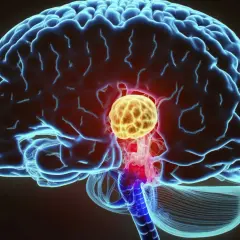Gruczolak przysadki objawy psychiczne: żółty guz w mózgu, naciskający na struktury, może wpływać na samopoczucie.