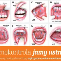 Rak dna jamy ustnej objawy - nie bagatelizuj niepokojących sygnałów