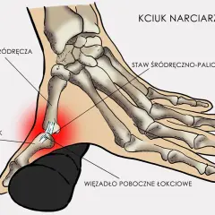 Anatomia kciuka narciarza: kość śródręcza, paliczek i staw śródręczno-paliczkowy. Czerwony obszar wskazuje ból.
