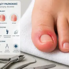 Duży palec u stopy z widocznym stanem zapalnym wokół paznokcia, wskazującym na wrastający paznokiec u stopy duzy palec. Obok infografika o objawach, przyczynach i leczeniu.