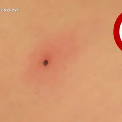 Jak bezpiecznie usunąć nimfę kleszcza? Szybki poradnik krok po kroku