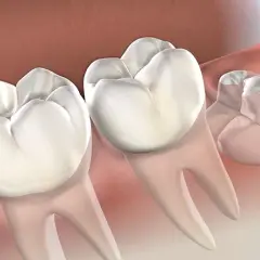 Medicamentos que se recetan después de una extracción dental y sus efectos