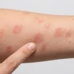 Ein Finger zeigt auf einen Arm mit mehreren kreisrunden roten Flecken auf der Haut. Mögliche Anzeichen für Hautkrebs oder andere Hautirritationen.