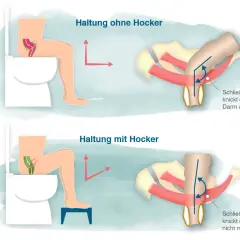 Hockstellung auf Toilette mit Hocker erleichtert den stuhlgang anregen, da der Darm gerade bleibt. Ohne Hocker wird der Darm abgeknickt.