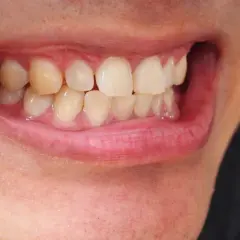 Uśmiech z lekko żółtymi zębami. Szukasz domowych sposobów na żółte zęby? Zobacz, jak można rozjaśnić uśmiech.
