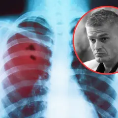 RTG płuc z widocznymi zmianami, sugerującymi raka płuc. Obok portret mężczyzny.