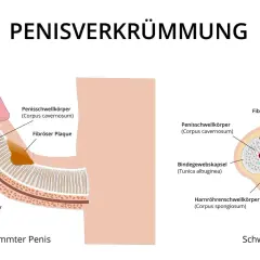Illustration zeigt einen verkrümmten Penis mit fibrosen Plaques, die den Penisschwellkörper beeinträchtigen. Ein "buried penis" ist hier nicht dargestellt.