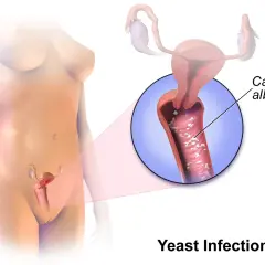 Illustration visar svamp i underlivet, orsakad av Candida albicans. Förstorad bild visar infektionen i slidan.