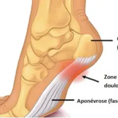 Anatomie du pied montrant l'aponévrose plantaire enflammée. Une bonne alimentation peut aider à gérer l'aponévrosite plantaire.