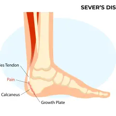 Schéma du pied montrant la maladie de Sever : douleur au talon (calcanéus) due à l'inflammation de la plaque de croissance, affectant le tendon d'Achille.