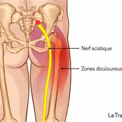 Illustration anatomique montrant le nerf sciatique et les zones douloureuses associées au symptôme de sciatique jambe droite.