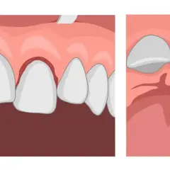 Illustrazione di gengive infiammate e denti che si allentano, suggerendo la possibilità di denti che cadono senza dolore.