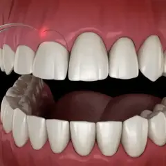 Zabieg gingiwektomii laserem. Czerwony promień lasera precyzyjnie modeluje dziąsło wokół białych zębów.