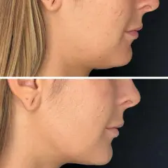 Före- och efterbilder som visar effekten av fillers i ansiktet, med en tydligare käklinje och fylligare kinder.