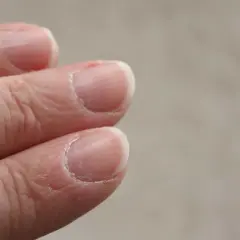 Pękająca skóra przy paznokciach, sucha i szorstka, wymaga nawilżenia.