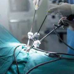 Chirurg wykonuje laparoskopię, co to jest? Precyzyjne narzędzia wprowadzane przez małe nacięcia.