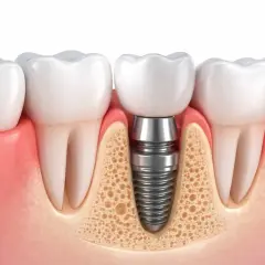 Sezione trasversale di denti con un impianto dentale inserito nell'osso mascellare, mostrando i diversi tipi di impianti dentali.