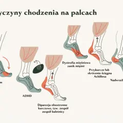 Ilustracja pokazuje, jak 7-letnie dziecko chodzi na palcach z powodu autyzmu, ADHD, dystrofii mięśniowej, przykurczu ścięgna Achillesa lub nadwrażliwości dotykowej.