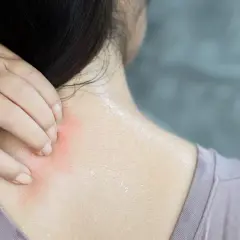 Mano che si gratta la nuca e il collo, con arrossamento e sudore. Un fastidioso prurito dietro la nuca e collo.