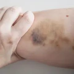 Eine Hand greift nach einem Bein mit dunklen Flecken, die auf einen Sturz oder Stoß hindeuten.