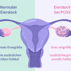 Porównanie jajnika: normalny vs. przy PCOS. Obraz pokazuje powiększony jajnik z licznymi niedojrzałymi pęcherzykami, co jest jednym z objawów PCOS.