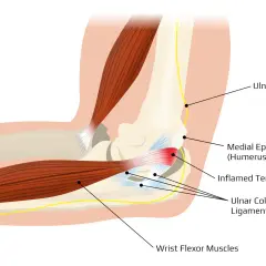 Anatomia łokcia z zapaleniem ścięgna, więzadła pobocznego łokciowego i nerwu łokciowego. Ból łokcia może być spowodowany stanem zapalnym.