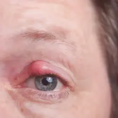 Ein roter, geschwollener Gerstenkorn am Augenlid. Dieses Gerstenkorn sieht ansteckend aus und verursacht Unbehagen.
