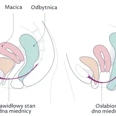 Ilustracja pokazuje różnicę między prawidłowym a osłabionym dnem miednicy. Ćwiczenia Kegla to naturalne sposoby na zwężenie pochwy i wzmocnienie mięśni.