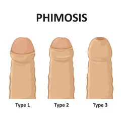 Różne stopnie stulejki (phimosis): od normalnego, przez typ 1, 2, 3, aż po typ 4, gdzie napletek jest mocno zwężony.
