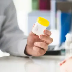 Lekarz podaje pacjentowi pojemnik na próbkę moczu, sugerując obecność erytrocytów świeżych w moczu.