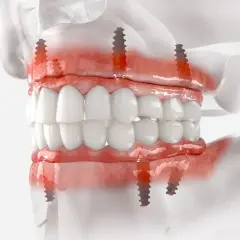 Model szczęki z implantami zygomatycznymi, pokazujący mocowanie protezy na implantach.