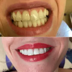 Wybielanie zębów u dentysty: Koszt, efekty i bezpieczeństwo. Poznaj fakty.