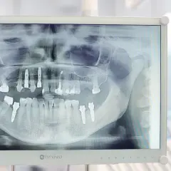 RTG zęba: Co naprawdę widzi dentysta? Ukryta próchnica i torbiele